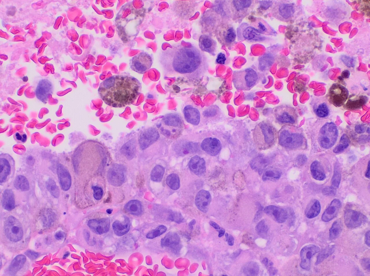 Histopathology of a biopsy of a melanoma metastasis to the brain