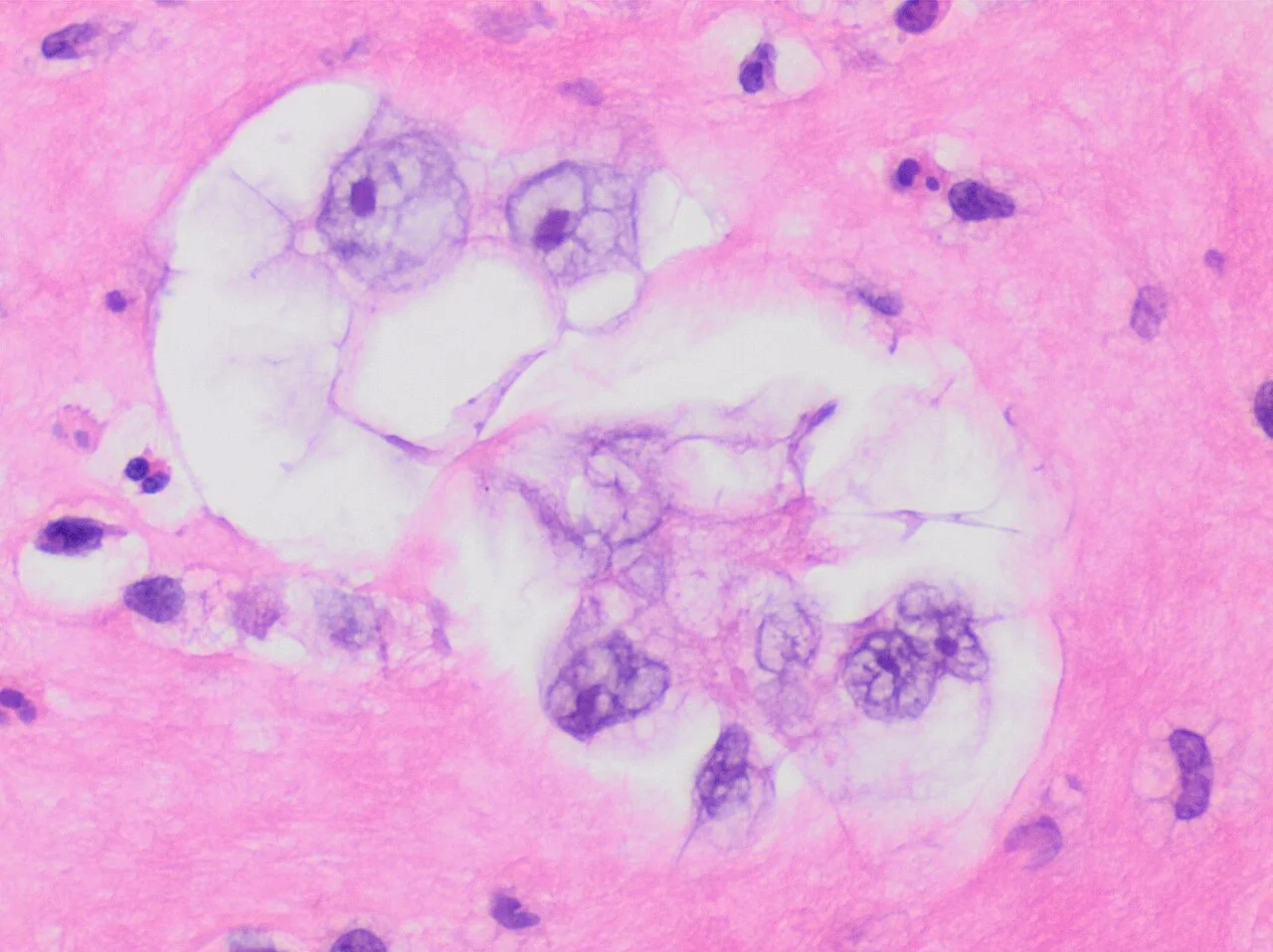 HE stained section of adenocarcinoma in peritoneal fluid