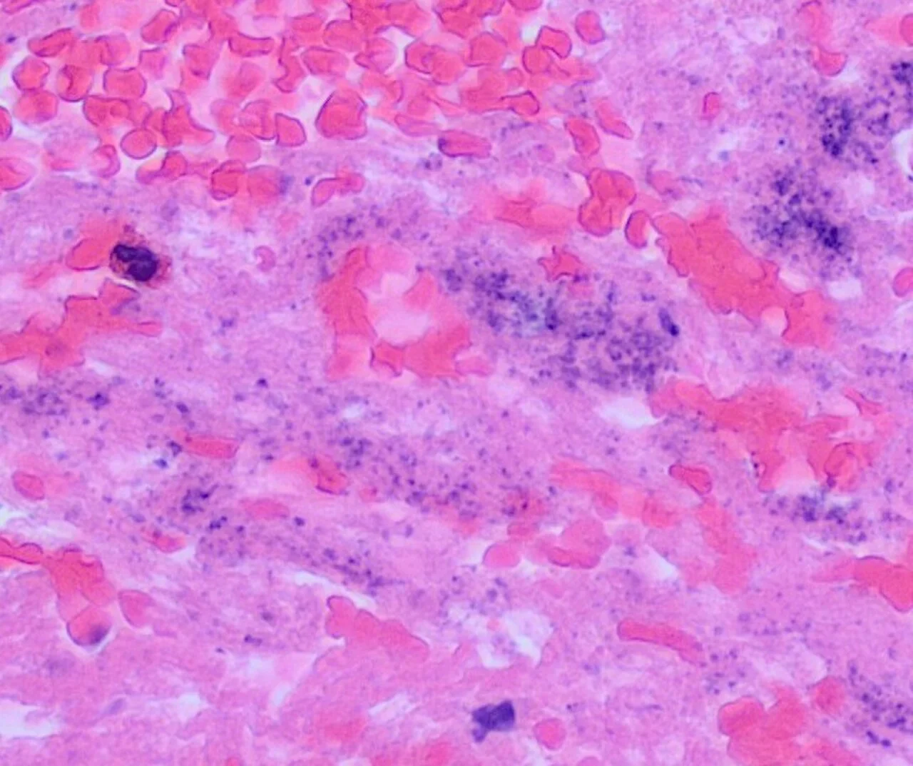 Histopathology of a blood clot with postmortem bacterial growth