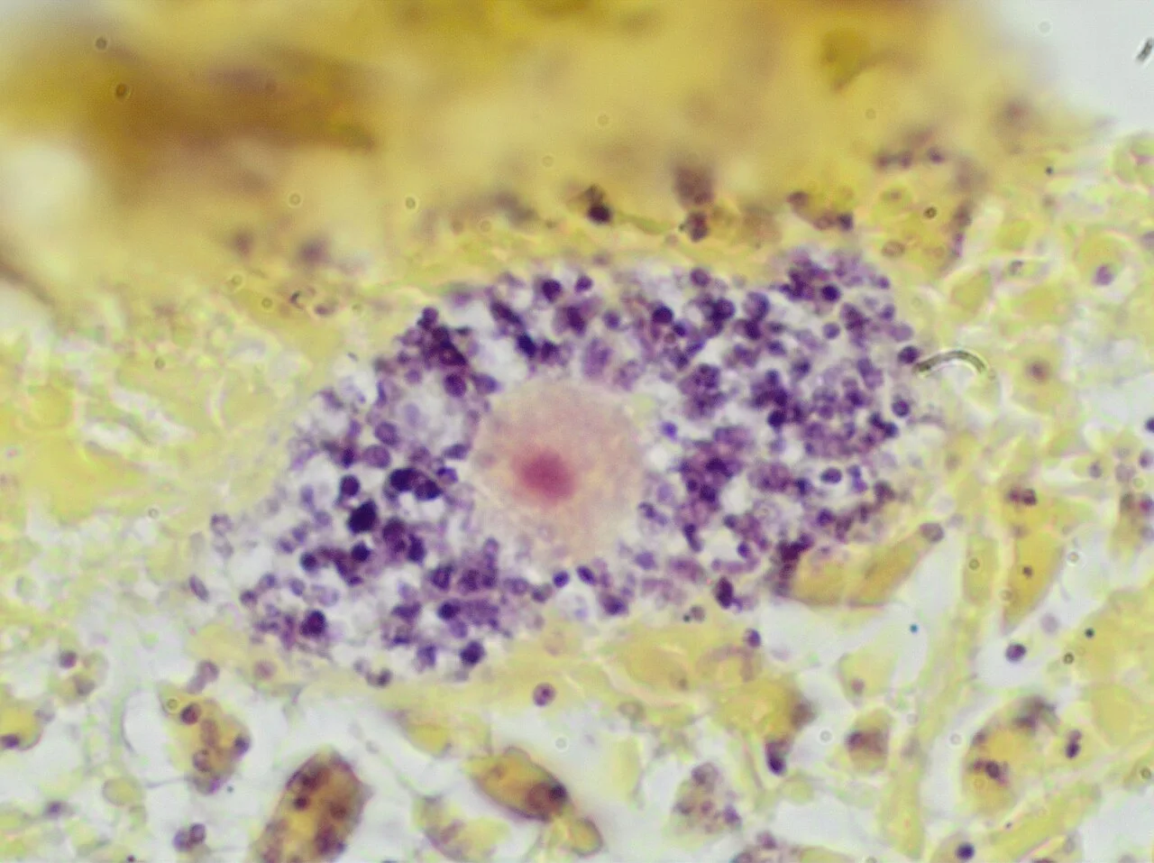 Gram stain of a macrophage with ingested S epidermidis bacteria
