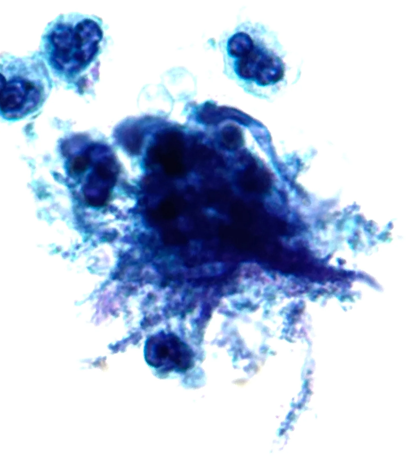 Actinomyces on Pap test