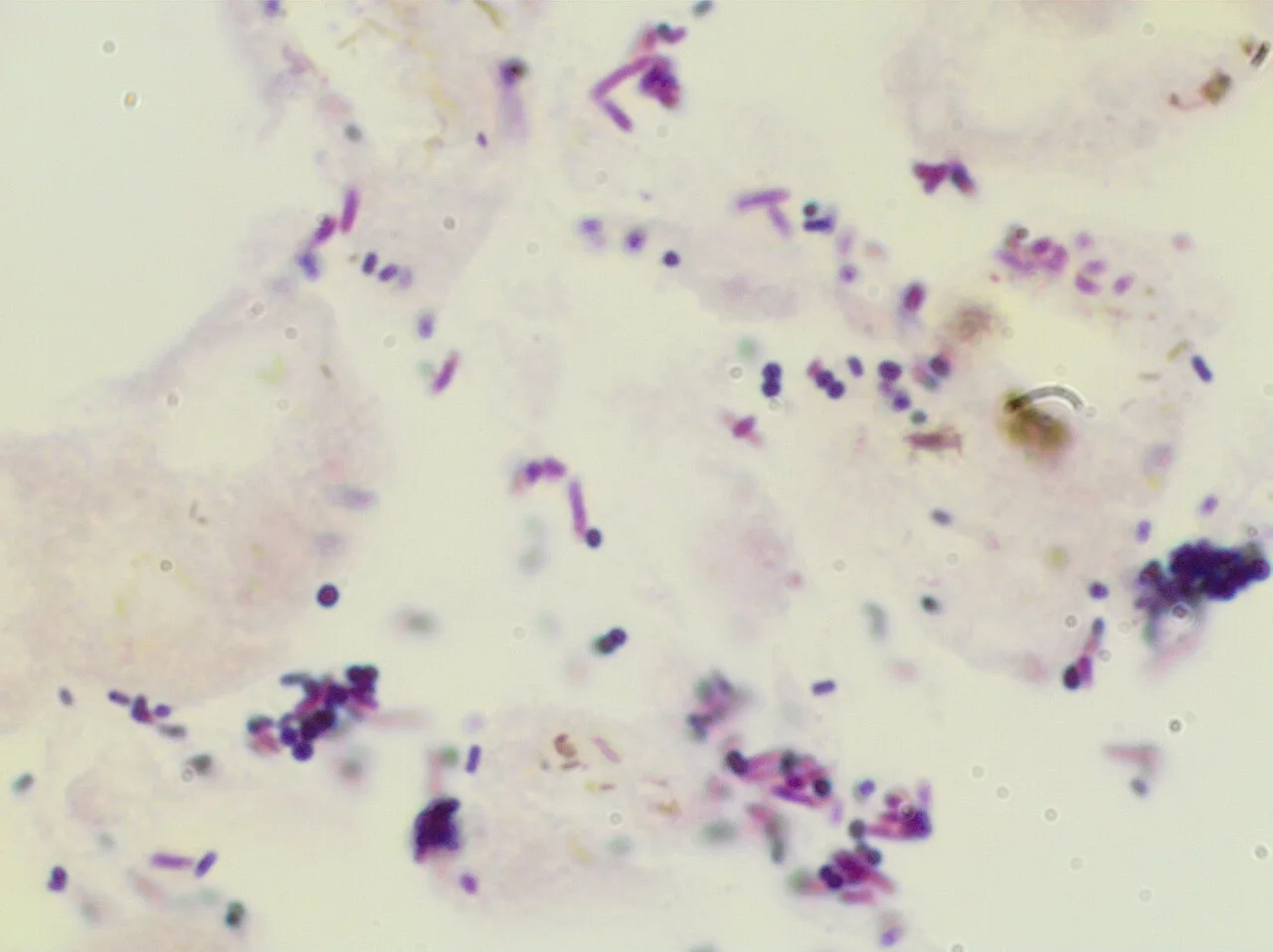 Gram negative rods and gram positive cocci 2