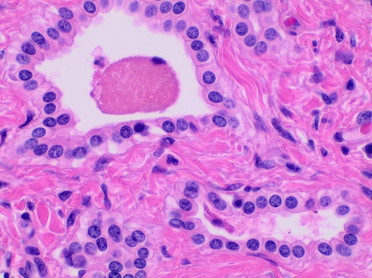 Histopathology of a bile duct hamartoma, high magnification