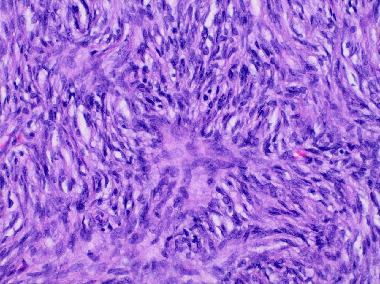 Histopathology of cartwheel pattern in dermatofibrosarcoma protuberans, original