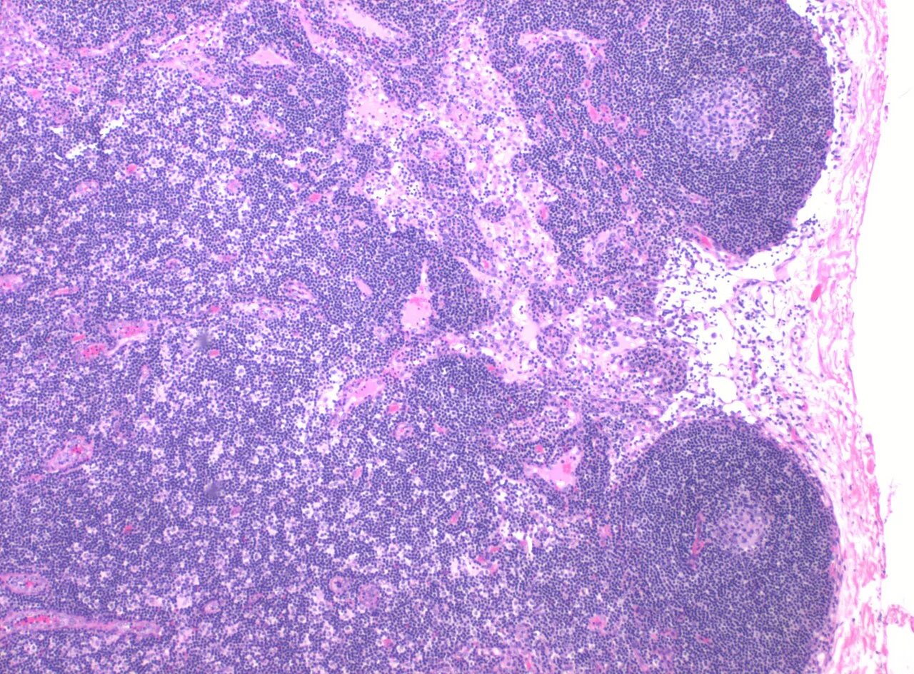 Histopathology of a reactive lymph node in cholecystitis