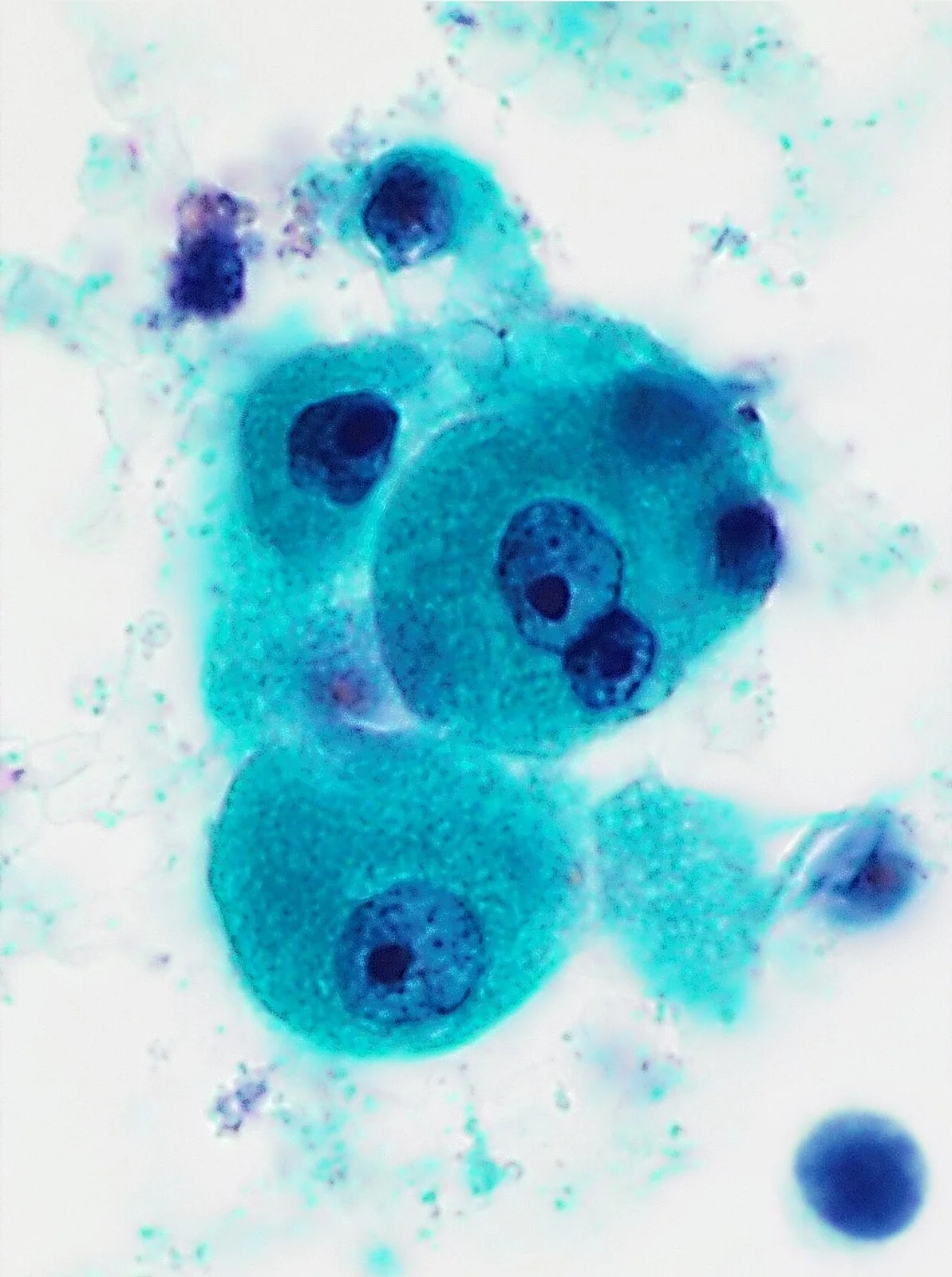 Cytopathology of Warthin's tumor, original