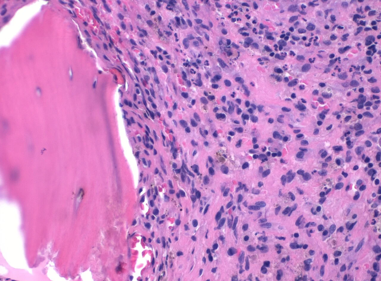 Histopathology of acute osteomyelitis