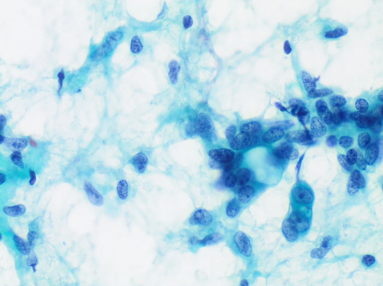 Cytopathology of pleomorphic adenoma, original