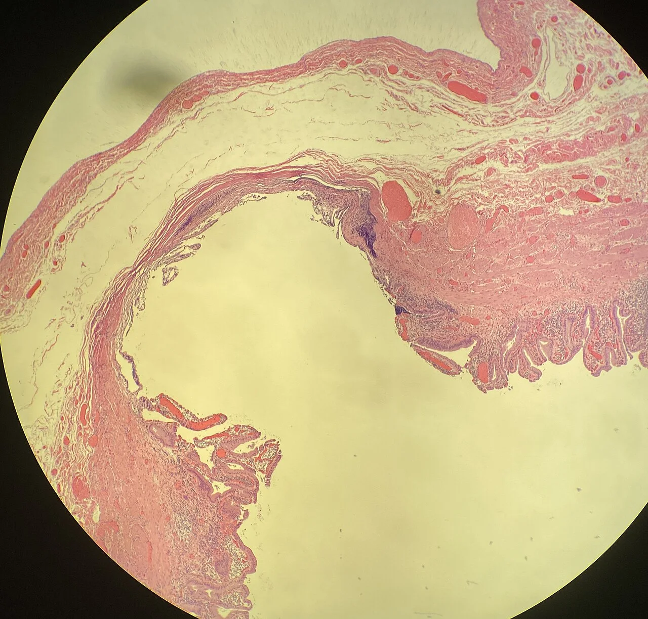 Histopathology of a false diverticulum of the gallbladder