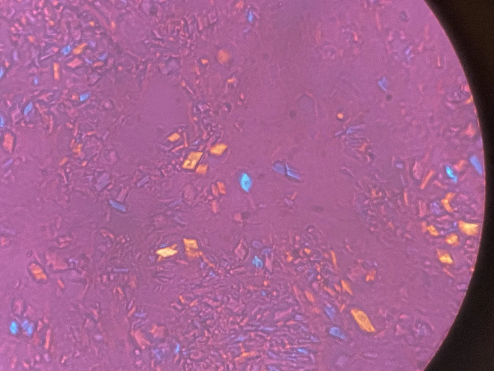 Birefringence microscopy of pseudogout