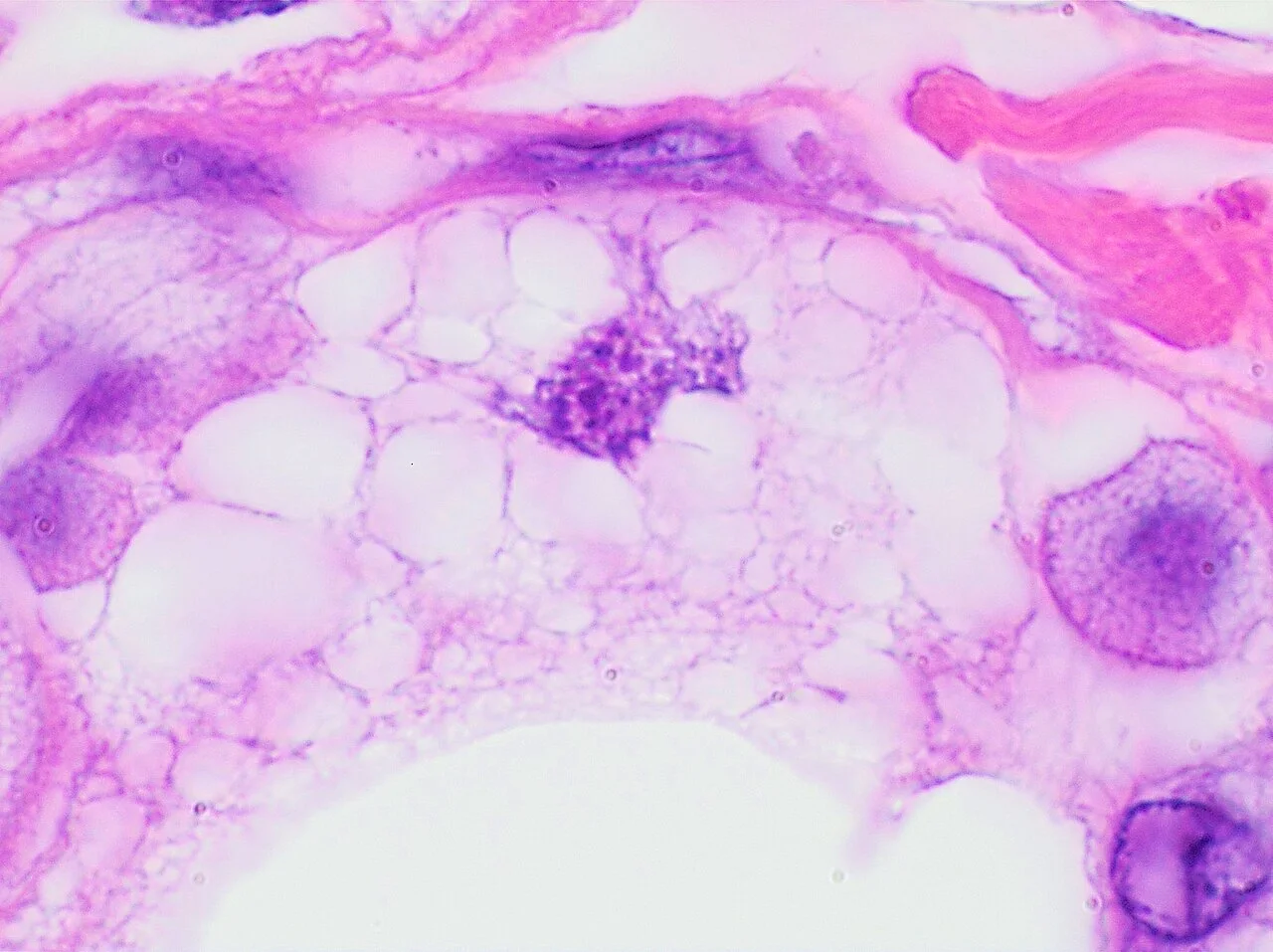 Histology of a lipoblast-like histiocyte in fat necrosis
