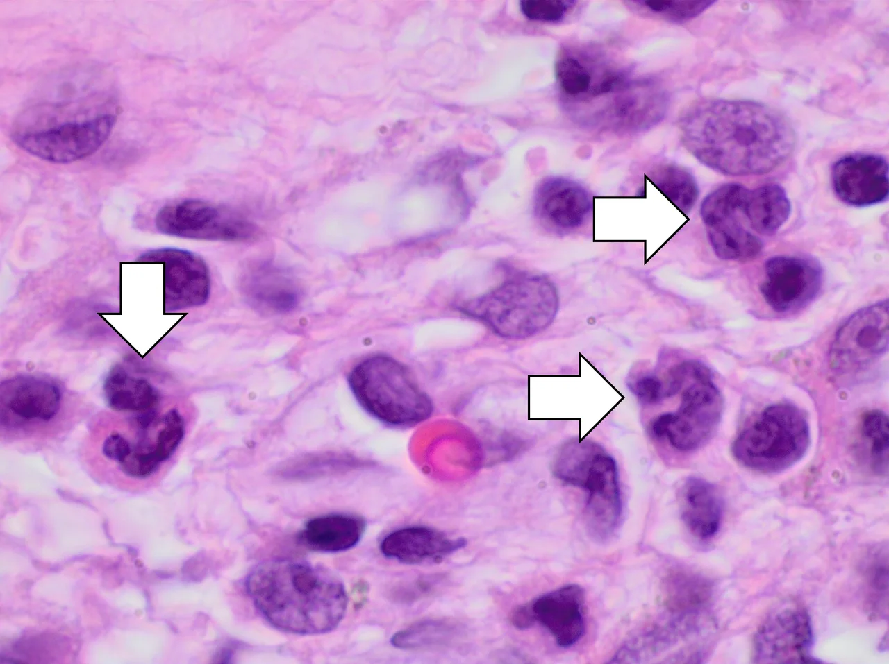 Histopathology of acute sinusitis