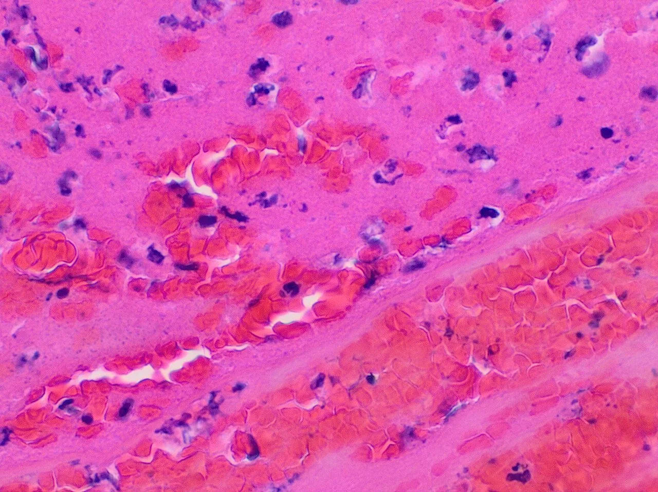 Histopathology of a fresh thrombus