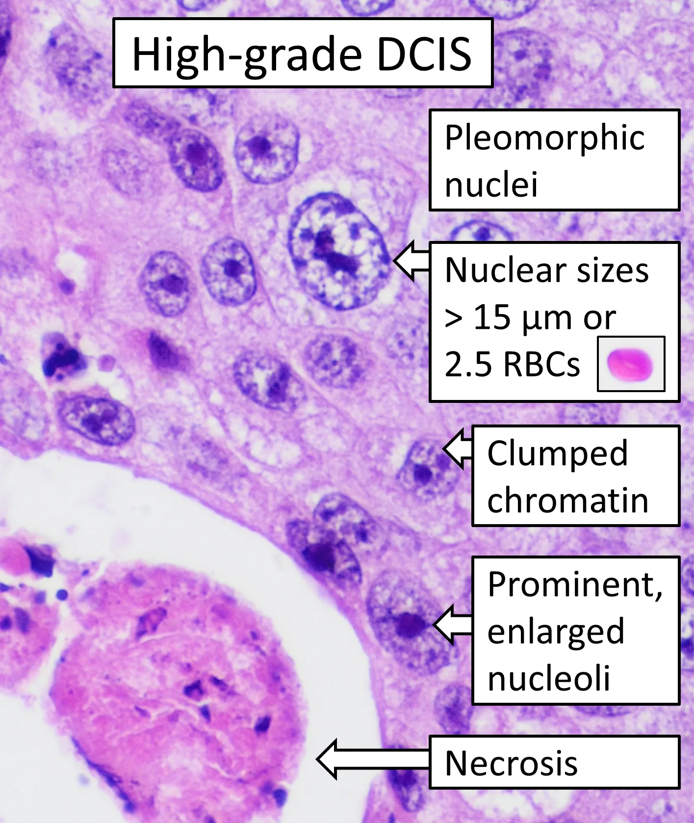 Histopathology of high-grade DCIS