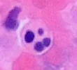 Apoptotic neutrophil with nuclear fragmentation