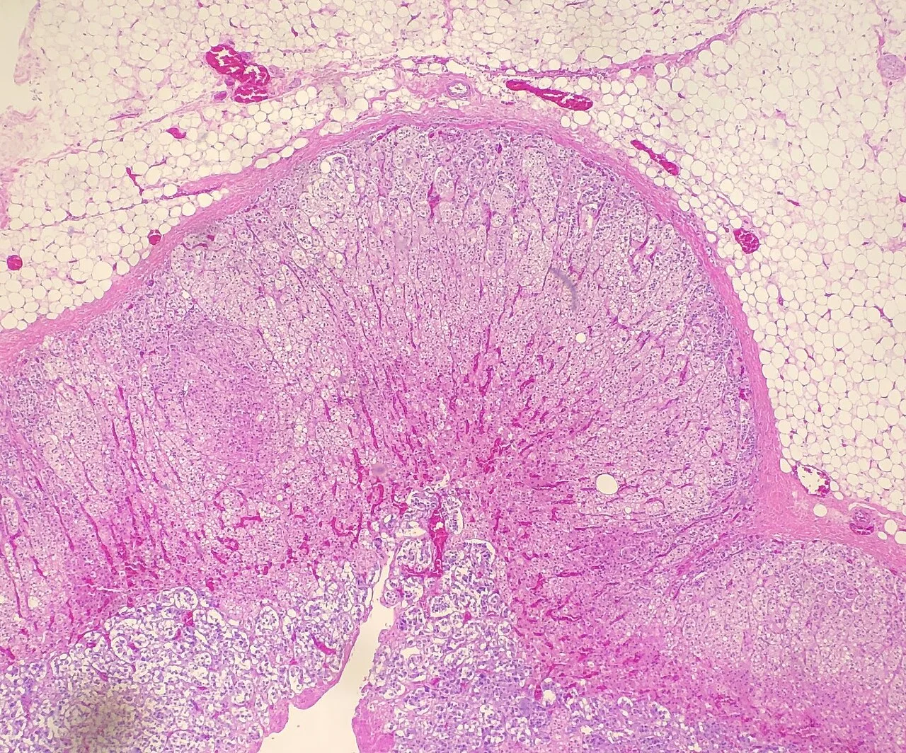 Histopathology of adrenal congestion