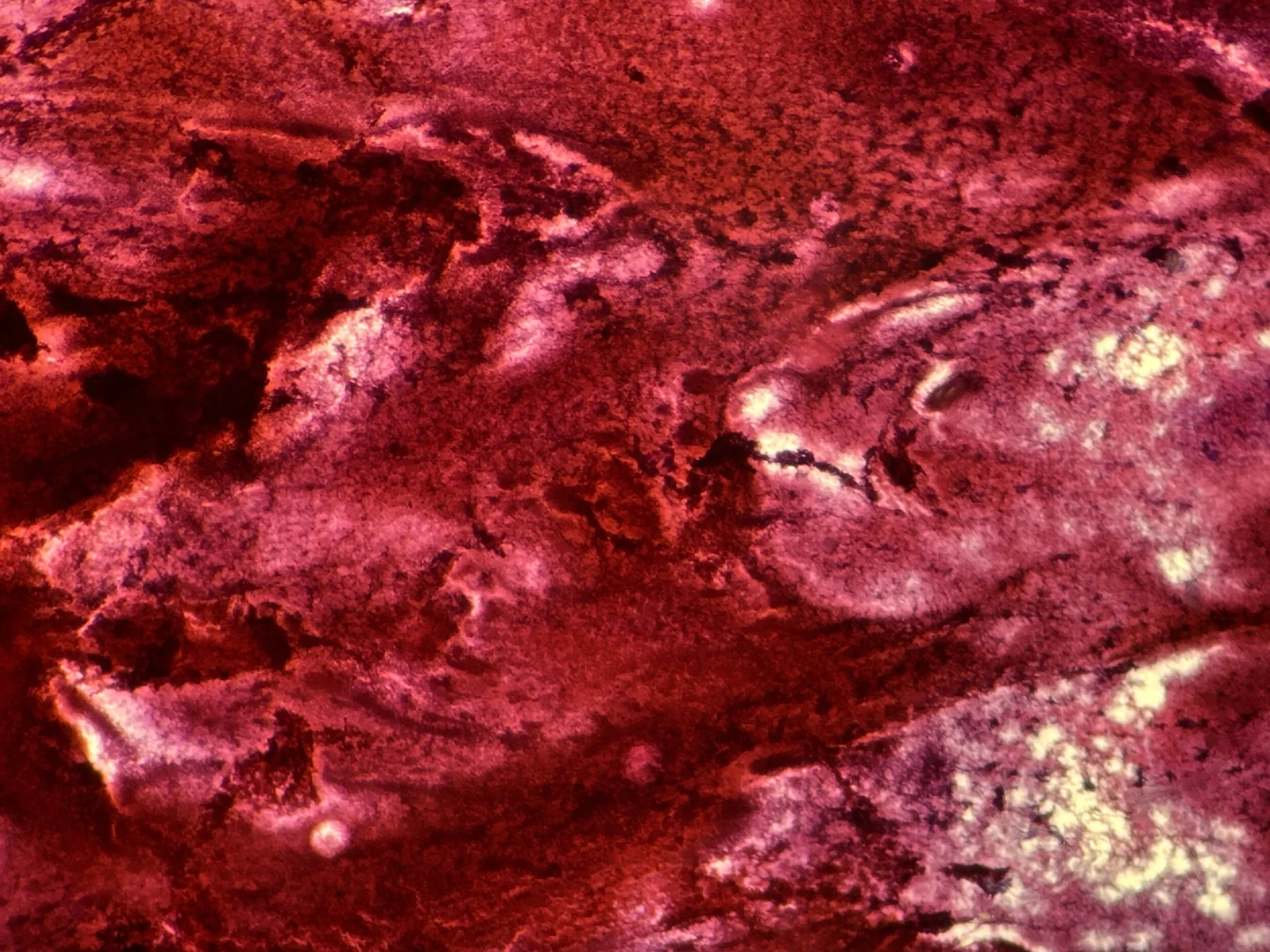 Blood seen on Pap smear from thyroid cyst, horizontal format