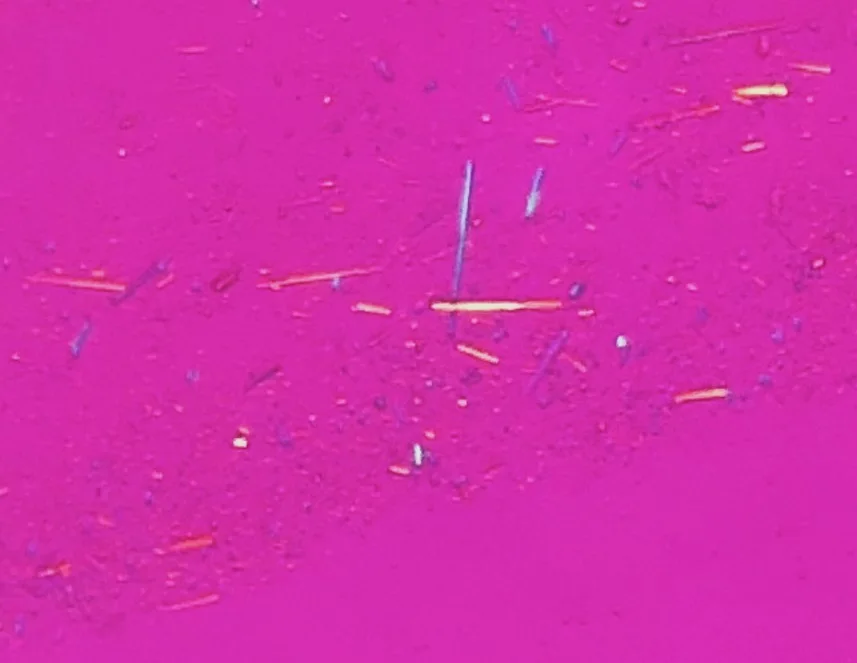 Birefringence microscopy of gout, original