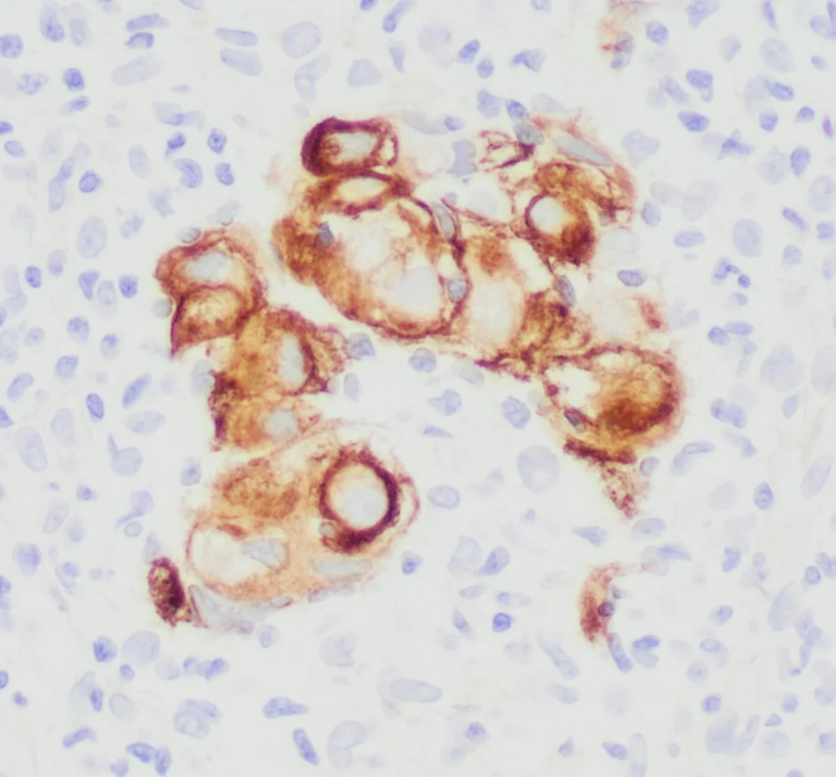 CK7 of metastatic carcinoma to lymph node
