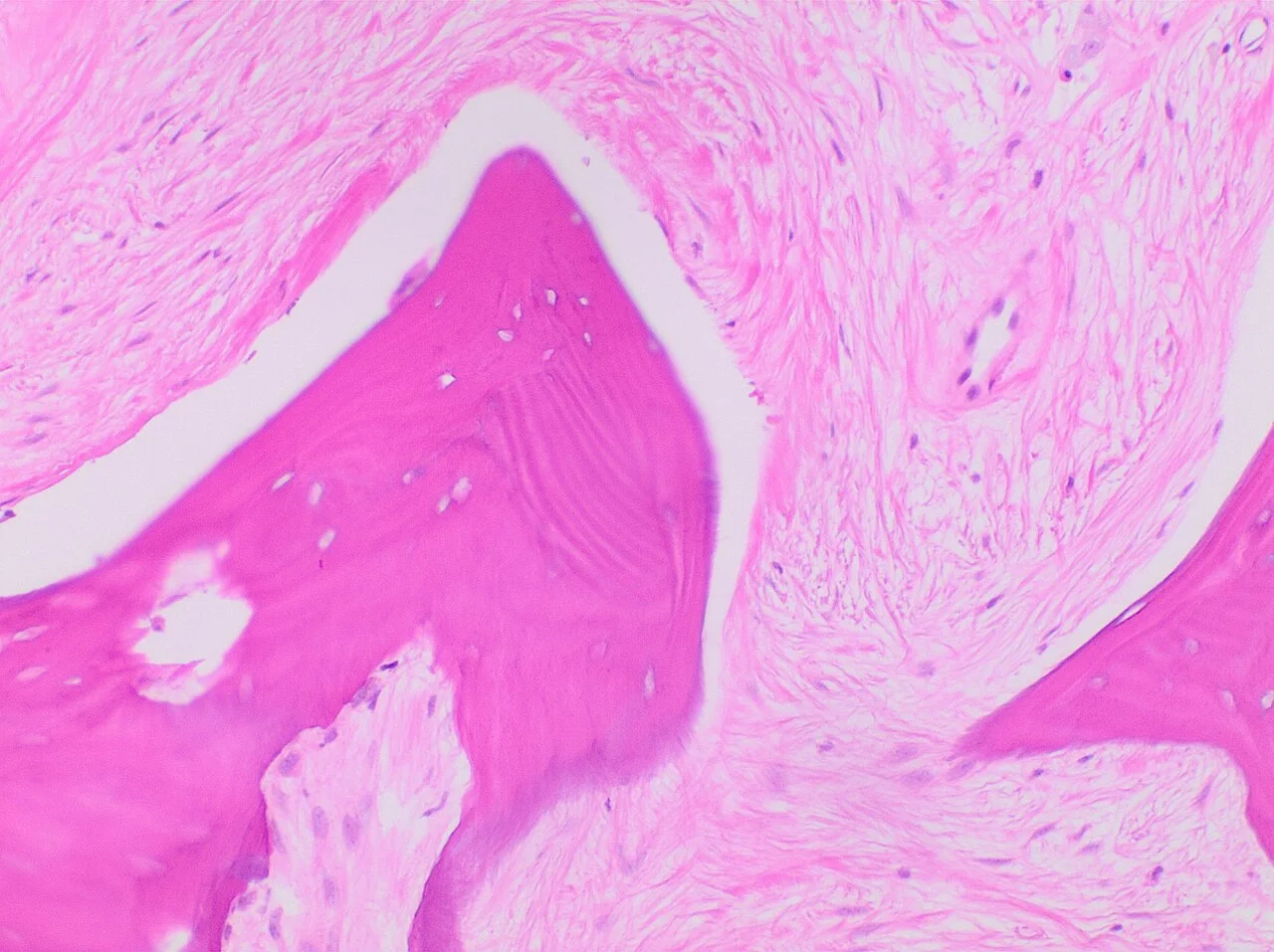 Histopathology of avascular necrosis