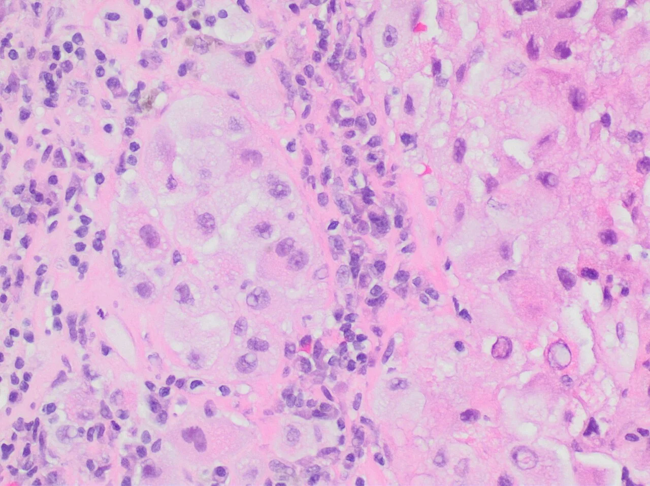 Histopathology of a metastatic melanoma to a lymph node
