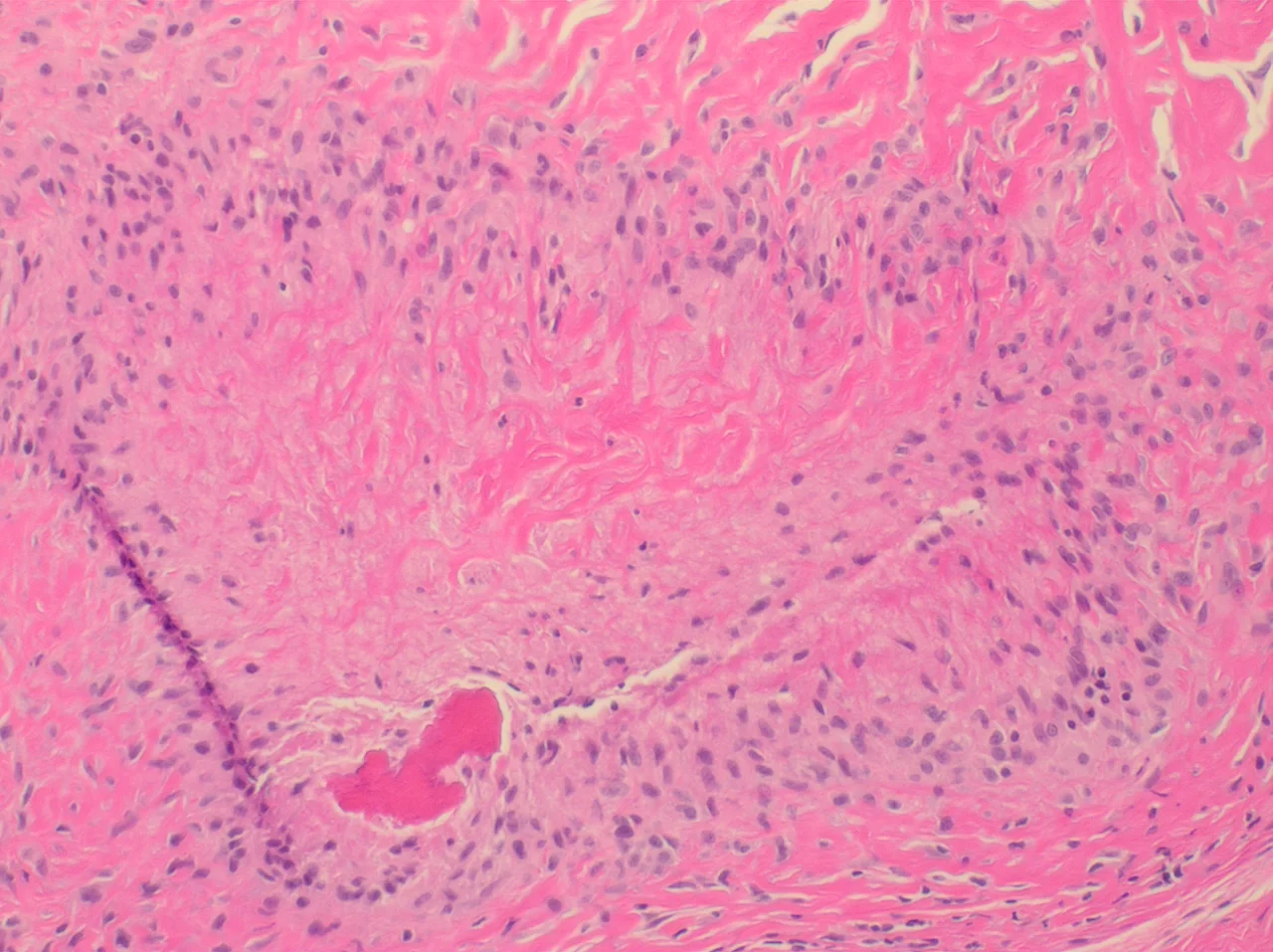 Histopathology of a rheumatoid nodule, original