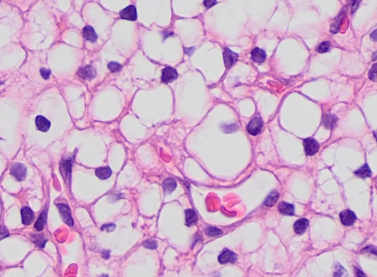 Histopathology of clear cell renal cell carcinoma, grade 1