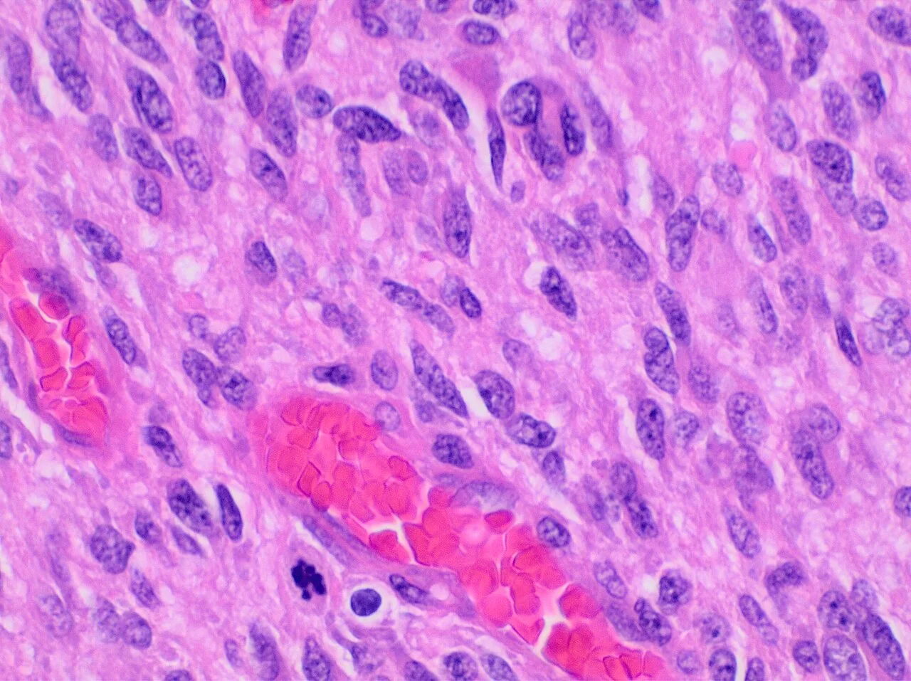 Histopathology of glioblastoma, high magnification