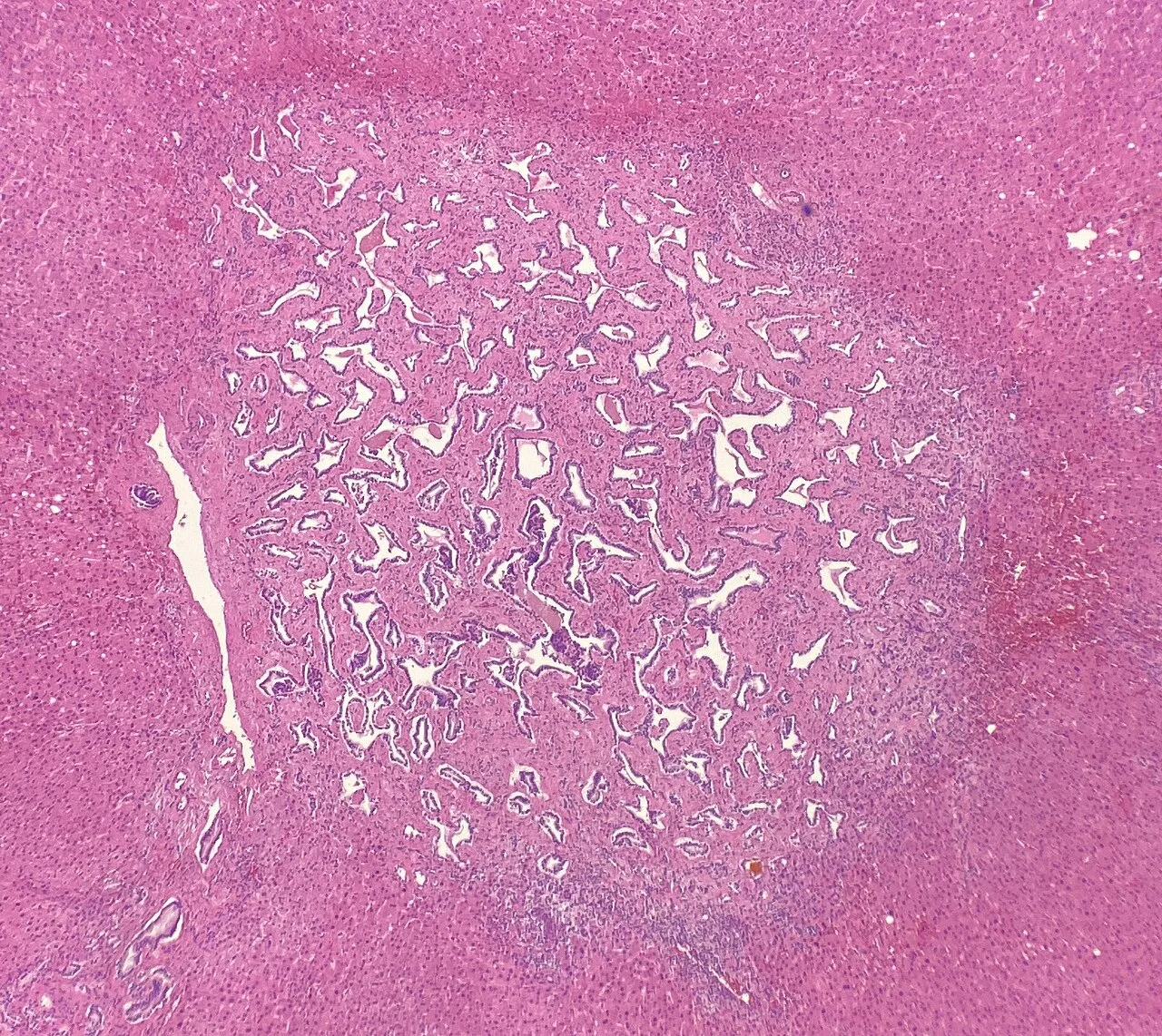 Histopathology of a bile duct hamartoma, low magnification