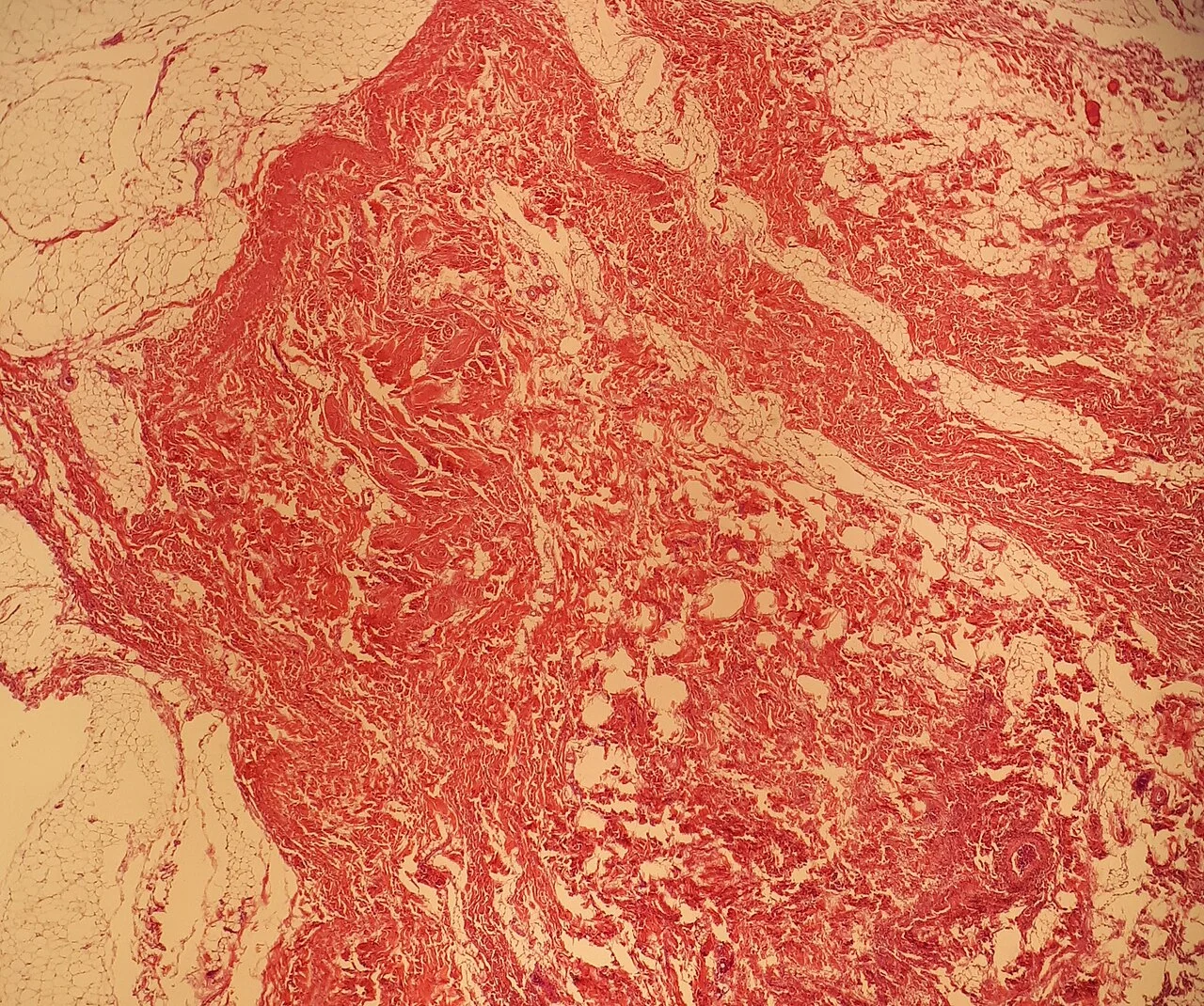 Histopathology of a fibrolipoma
