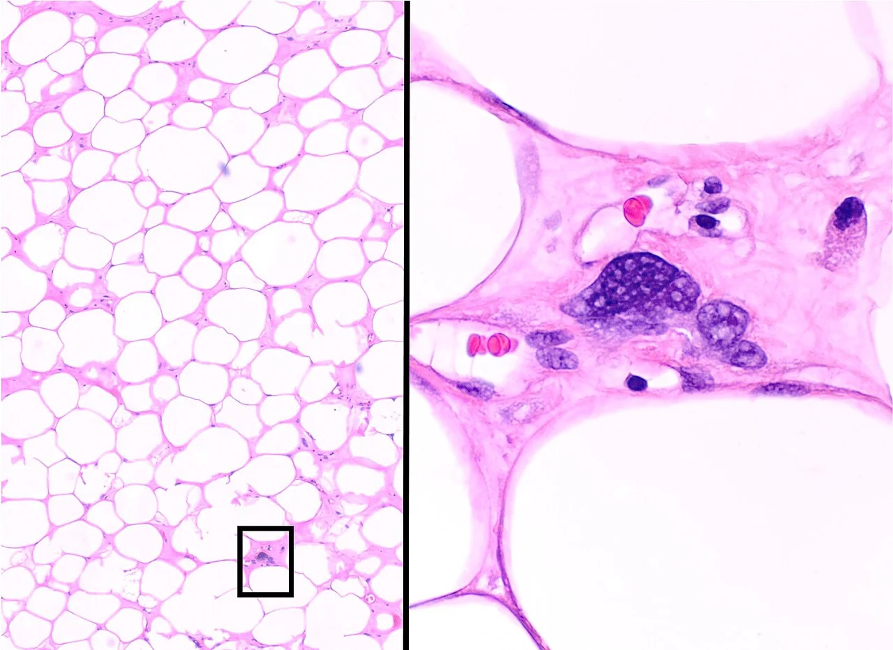 Histopathology of an atypical lipomatous tumor or well-differentiated liposarcoma, lipoma-like subtype