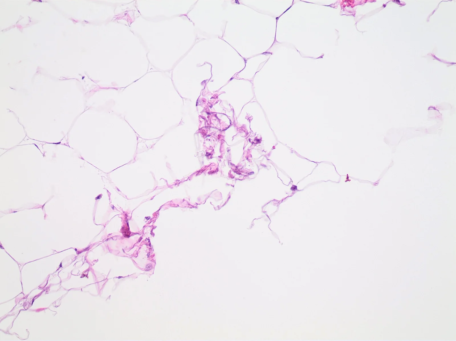 Adipose tissue with crumpling artifact due to insufficient fixation
