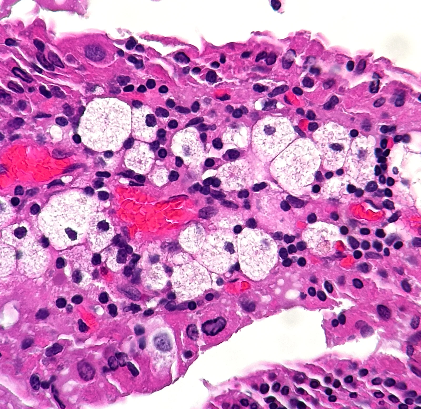 Cholesterol polyp with reactive changes