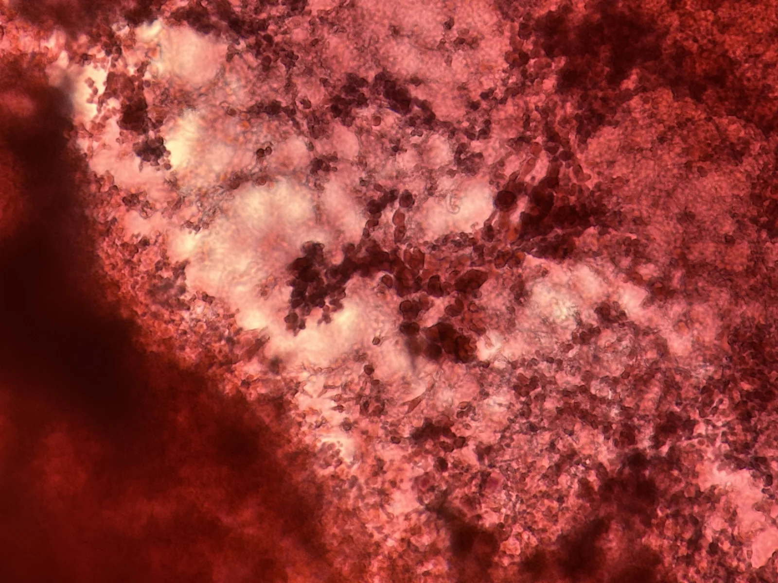 Blood seen on Pap smear from thyroid cyst, high magnification