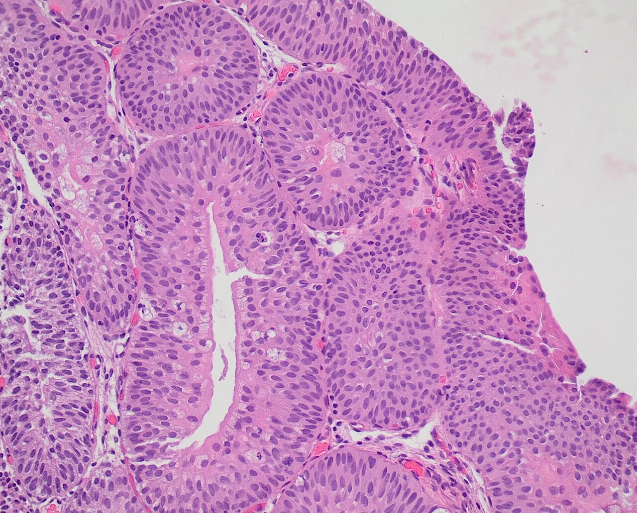 Histopathology of inverted urothelial papilloma