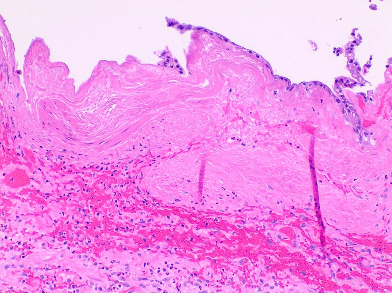 Histopatholgoy of acute gangrenous cholecystitis