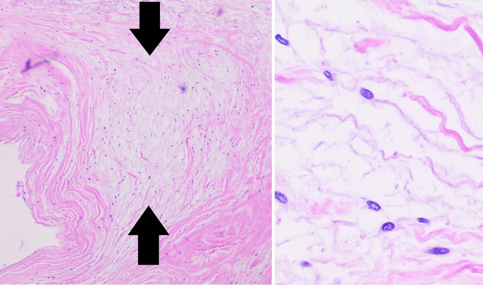 Histopathology of mitral valve with myxomatous degeneration